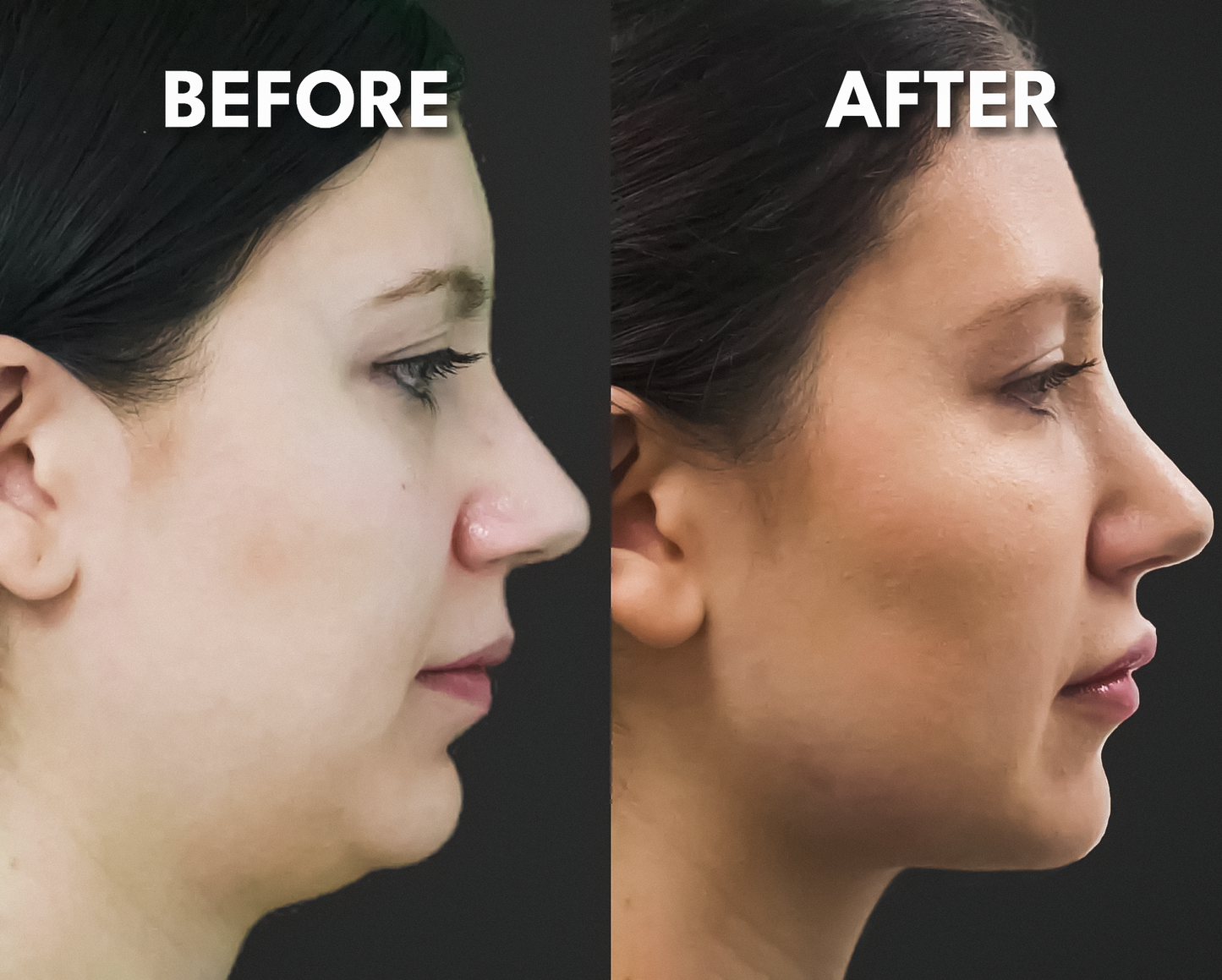 Lunava Facial Lifter